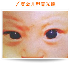 婴幼儿型青光眼