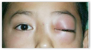 眼球运动障碍和复视